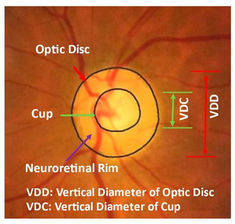 Cup Disc Ratio