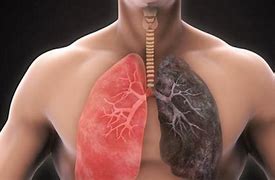 Image result for lung disease 一切肺病