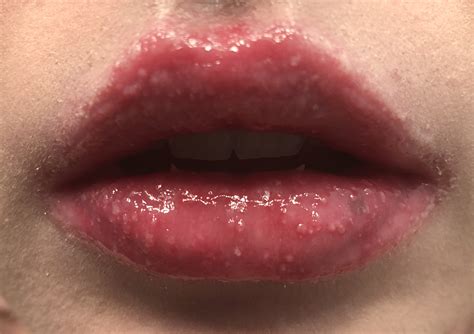Different Types Of Bumps On Lip at William Moser blog