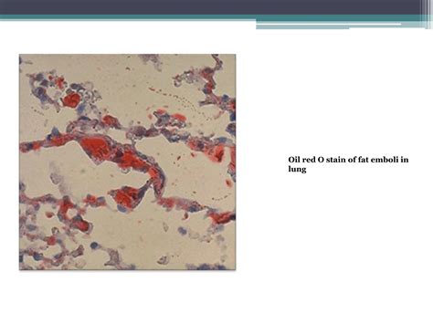 Lipid staining new slideshare which help | PPTX