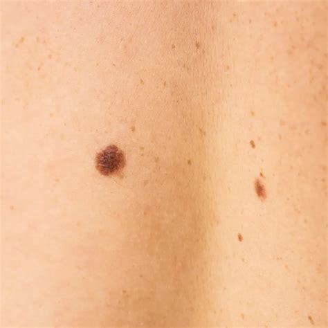 Melanocytic Nevus Dermoscopy: Clinical Patterns & Diagnosis Guide | IBOOLO