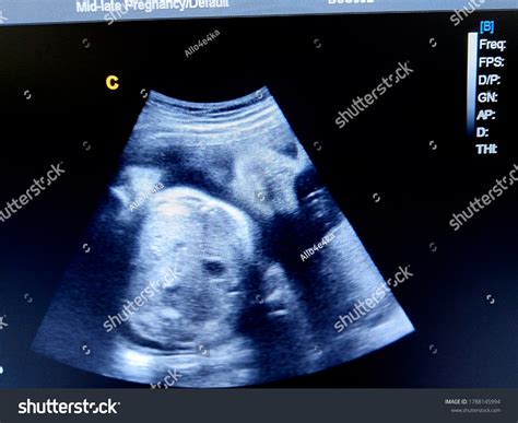Fetal Face 36 Weeks By Ultrasound Stock Photo 1788145994 | Shutterstock