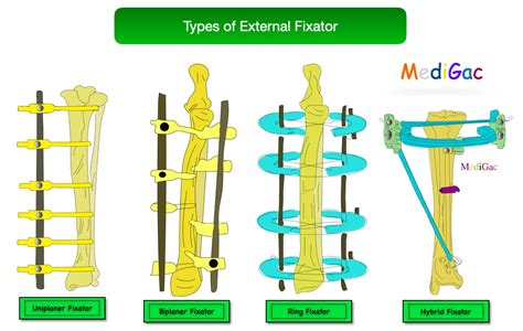 Image result for Lrather Fixation