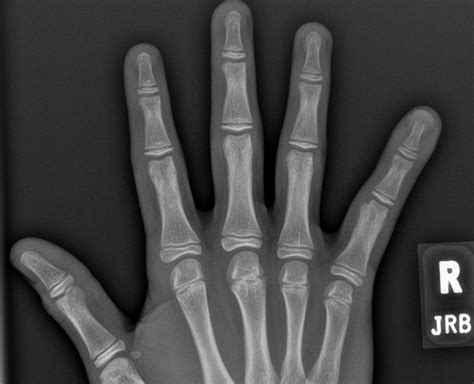 Distal Phalangeal Tuft Fracture with osteolysis | Radiology Case | Radshare.net