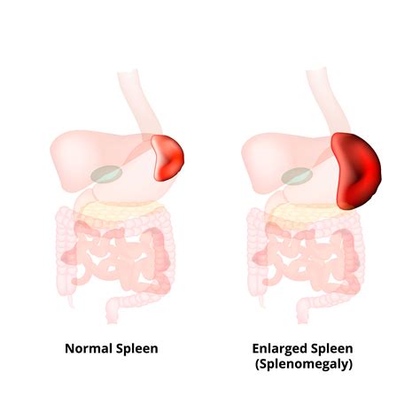 Abdominal Pain When Walking or Standing - Hood MWR
