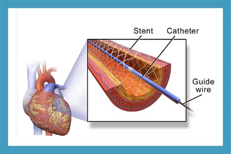 Carotid Stenting | 9212087571 | Carotid Stenting Treatment in Saket ...