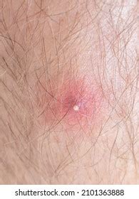 Image result for Exploding Massive Knee Abscess