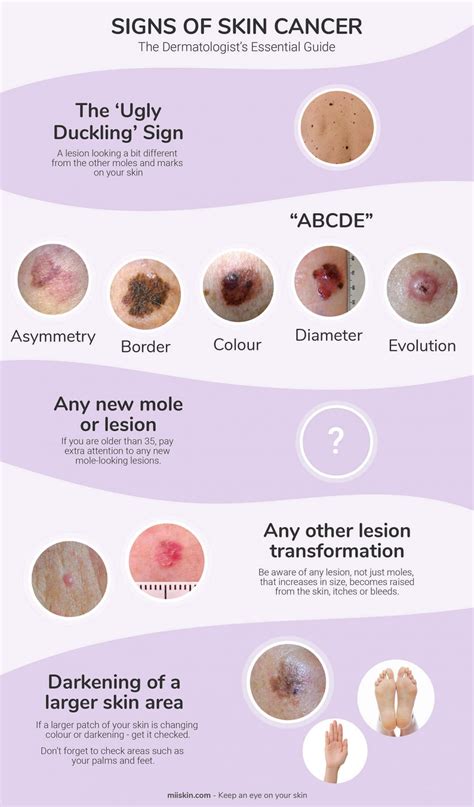 Types Skin Cancer Signs 的图像结果