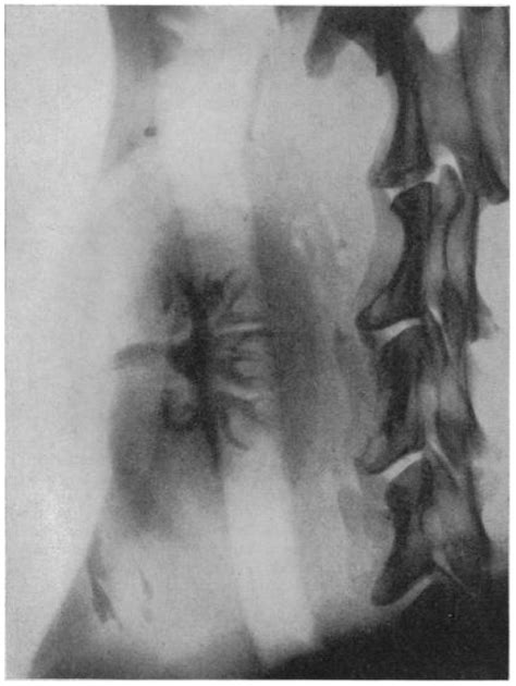 Kidney Transplantation and Diagnostic Imaging: The Early Days and ...