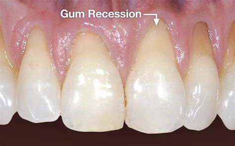 Gum Recession – What to Do About It? | Agape Dental Clinic Mill Woods