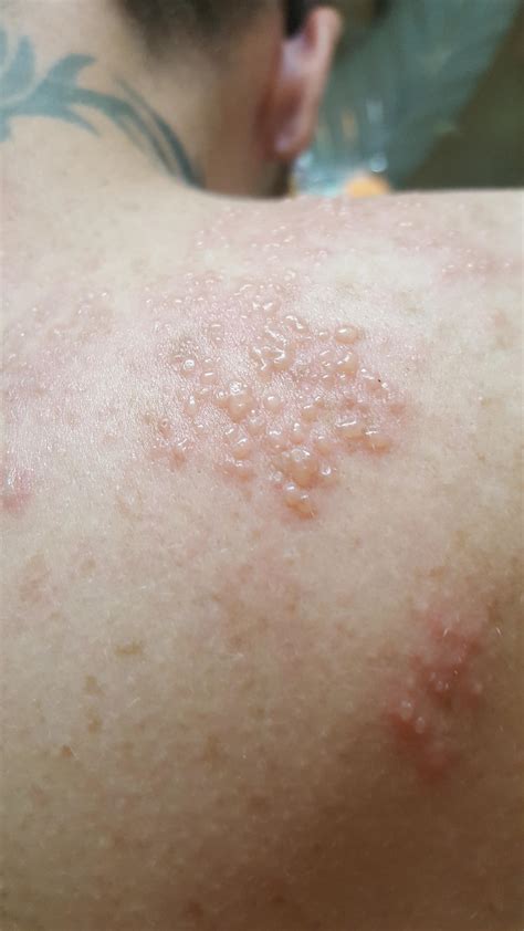 Shingles? My bf has this on his L shoulder, neck and a little on his chest. He thinks it