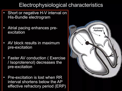 Pre-excitation Syndromes.ppt