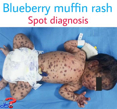 Congenital Rubella Blueberry Muffin Rash