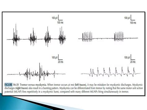 Image result for EMG Tutorials