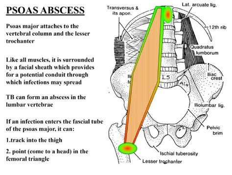 Image result for Psoas Sign