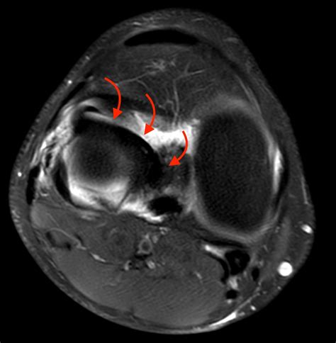 Bucket-handle Tear of the Meniscus | Radsource