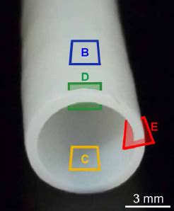 Breakthrough!! Bioengineered vessel for dialysis evolve as patient's ...
