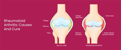 Rheumatoid Arthritis: Symptoms, Causes & Treatment Options