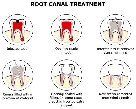 Root Canal Symptoms