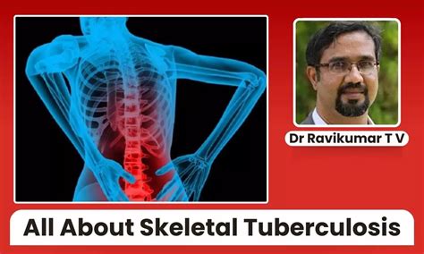 Skeletal Tuberculosis: Understanding Its Impact on Bones and Joints ...