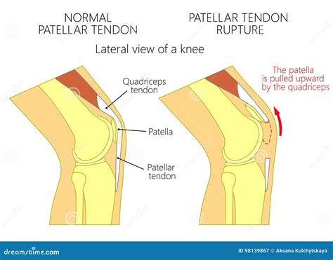 Tendon Rupture Anatomical Example, Vector Illustration Diagram ...