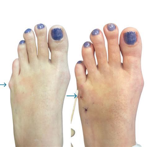 Tailors Bunion Bunionette (tailors Bunion) Should I Get The Surgery?