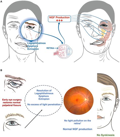 Frontiers | Combining early lower eyelid surgery with neuromuscular retraining for synkinesis ...