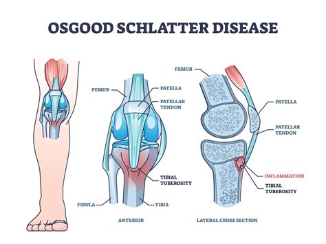 Osgood-Schlatter - knæproblemer - KropsVærkstedet