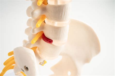 Laminotomy vs. Laminectomy — What's the Difference?