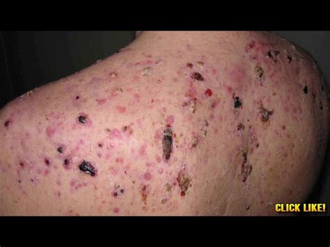 Image result for Exploding Back Zits