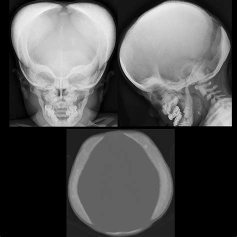 Toulouse Lautrec Syndrome