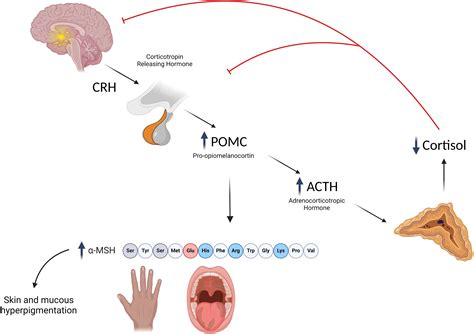 Addisons Diseases Addison's Disease – Causes, Symptoms, Diagnosis,