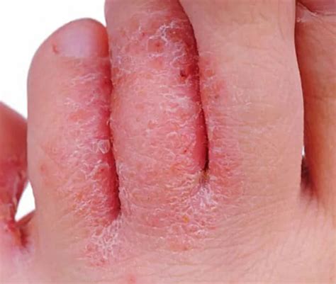 Fungal Infection & Jock Itch