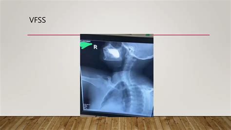 Ca larynx management and intense care in hospital | PPT