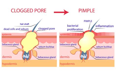 Acne Pustules: Causes, Symptoms & Ayurvedic Remedies – Vedix