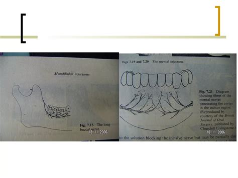 Local Anesthesia Injection 的图像结果