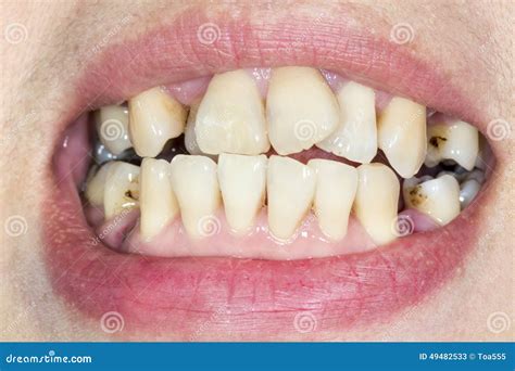 Crooked Teeth before Braces Stock Image - Image of healthy, oral: 49482533