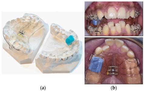 Wearable Orofacial Technology and Orthodontics