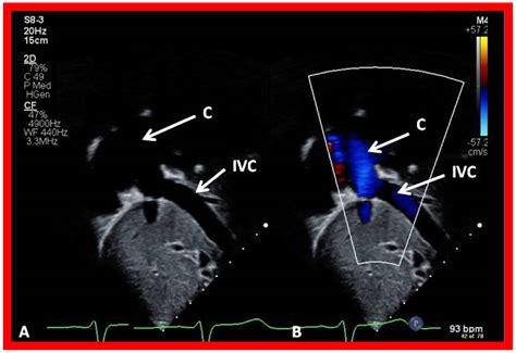 Double-Inlet Left Ventricle