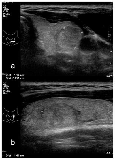 Non-Marked Hypoechogenic Nodules: Multicenter Study on the Thyroid ...