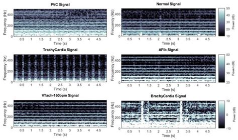 The Use of Time-Frequency Moments as Inputs of LSTM Network for ECG ...