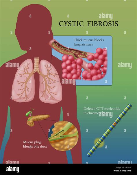 Lung Transplant Cystic Fibrosis