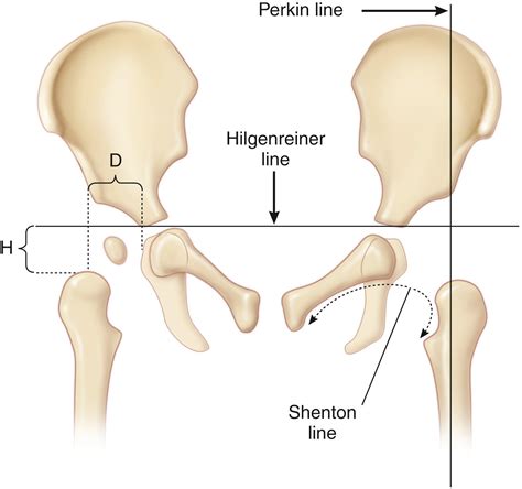Developmental Dysplasia of the Hip - Clinical Tree