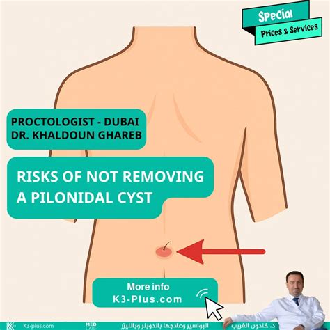 Pilonidal Cyst