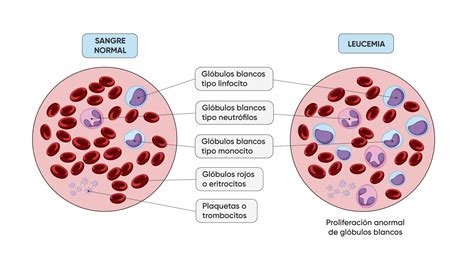 Leucemia - Mundo Cancer