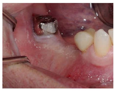 Study of Immediate Implants Placed in Mandibular Alveolar Bone ...