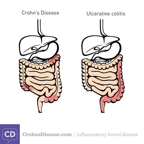 Crohn's Vs Ulcerative Colitis