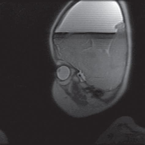 The brain and cerebral visual impairment - Clinical Tree