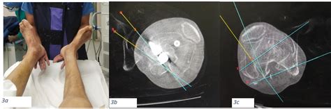 Comparative study to measure femoral malrotation in inter-trochanteric ...
