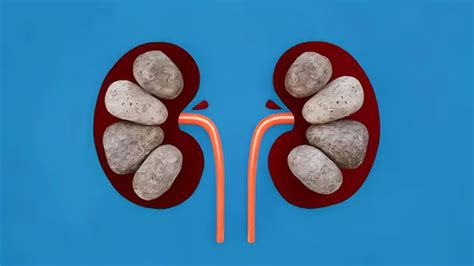 What Size Of Kidney Stones Need Surgery? Experts Explain | OnlyMyHealth